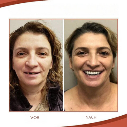 BowLift | Biocompatible  Prosthesis Set for Pain-Free Fit and Natural Smile
